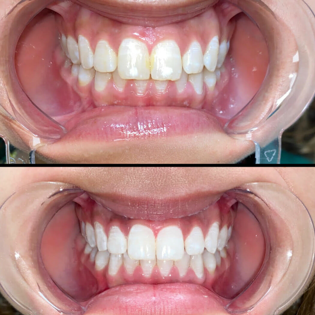 Laser Teeth Whitening Before / After