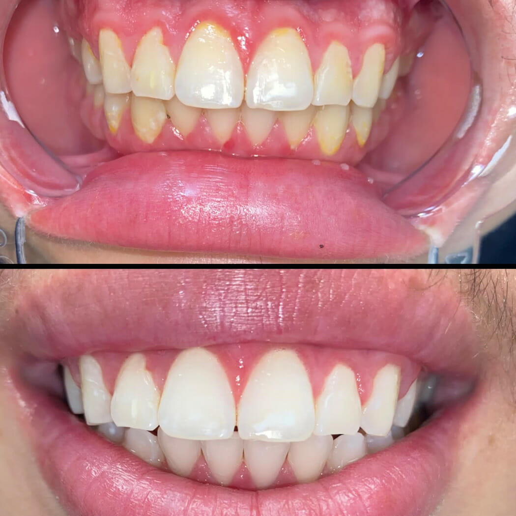 Laser Teeth Whitening Before / After