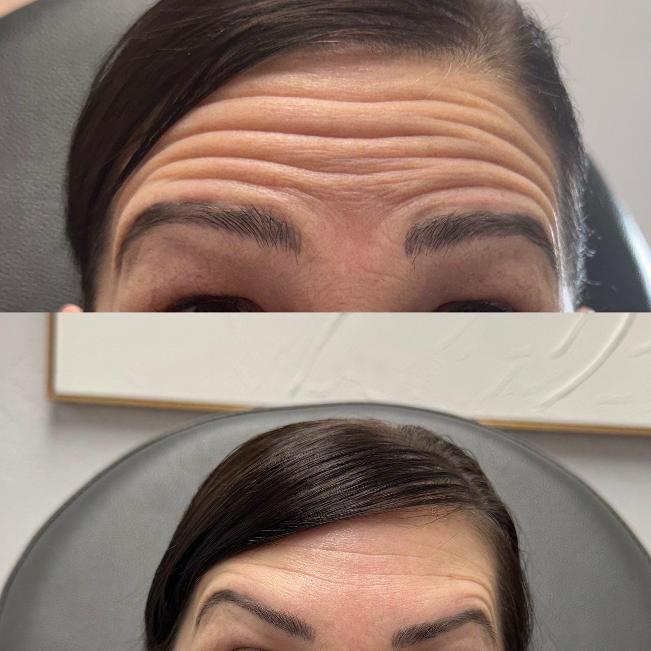 Neurotoxin Injection Pricing