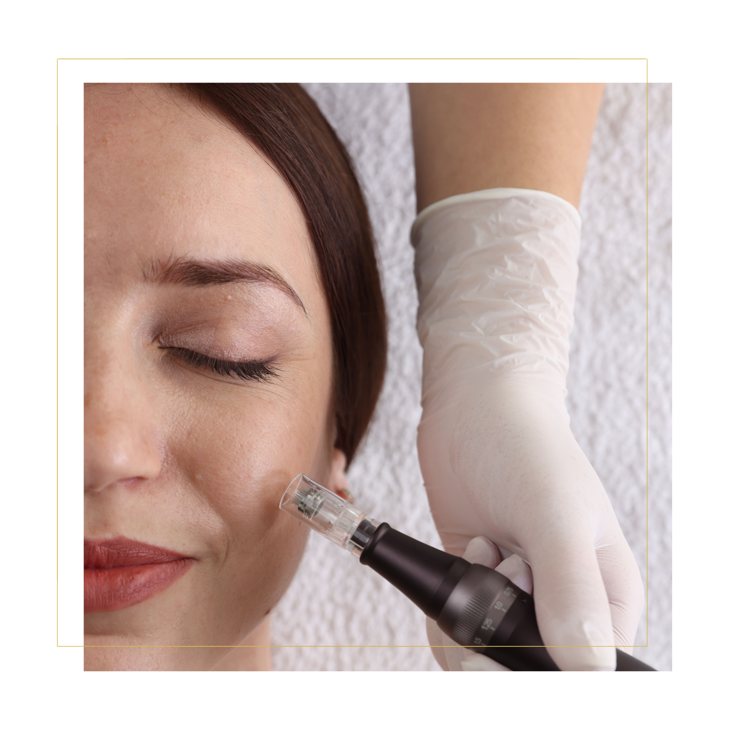 RF Needling In Grand Junction, Co.